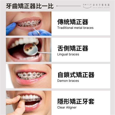 方形矯正線作用|不同的矯正方式有什麼差別？介紹常見的三種矯正方。